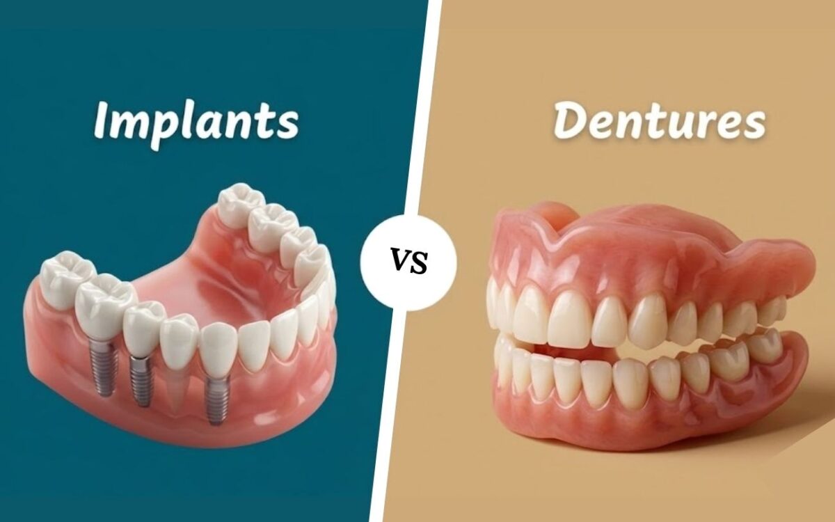 Dental Implants vs Dentures